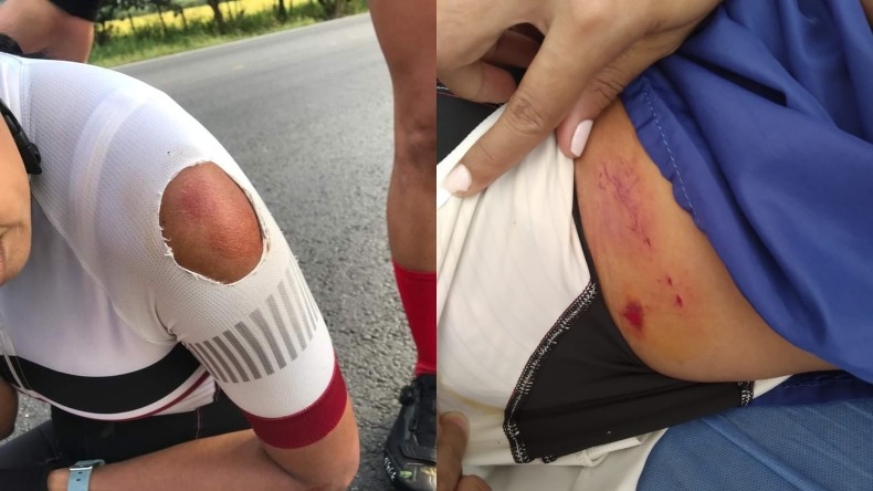 Mujer ciclista arrollada por un patrullero de la Policía en accidente presentado en la vía Ibagué-Alvarado resultó con una fisura de cadera