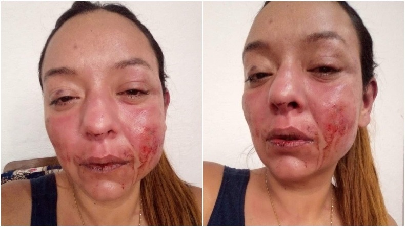 Mujer denuncia fuertes agresiones por parte de su expareja sentimental en Ibagué 