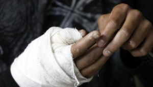 Le amputaron el dedo a un hombre que resultó quemado por pólvora en Ibagué